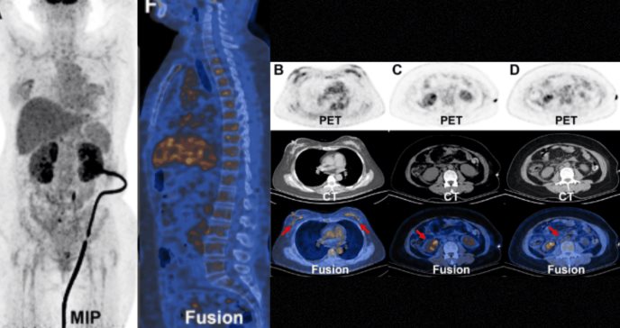Descubren metástasis renal atípica por cáncer de mama bilateral en mujer de 49 años anémica 