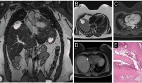 Mujer desarrolla carcinoma de células claras diafragmático ligado a endometriosis sin compromiso pélvico