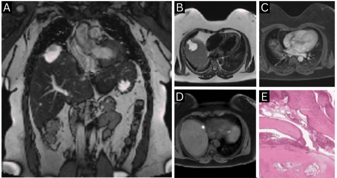Mujer desarrolla carcinoma de células claras diafragmático ligado a endometriosis sin compromiso pélvico
