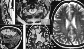 Pérdida visual, parálisis y  Lhermitte: Enfermedad de Marburg como variante de esclerosis múltiple