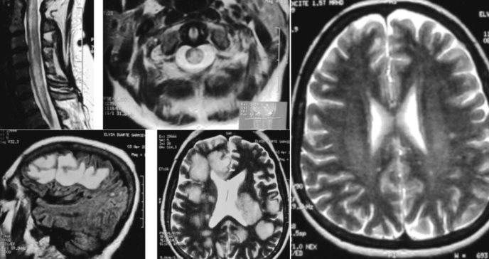 Pérdida visual, parálisis y  Lhermitte: Enfermedad de Marburg como variante de esclerosis múltiple