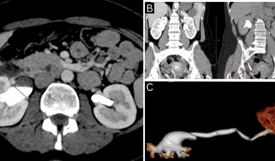 Copa menstrual mal posicionada ocasiona ureterohidronefrosis unilateral en mujer de 30 años