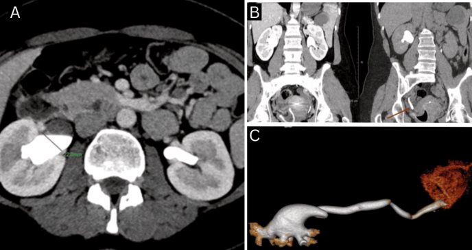 Copa menstrual mal posicionada ocasiona ureterohidronefrosis unilateral en mujer de 30 años