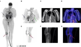 Sepsis por Haemophilus influenzae con taponamiento cardíaco y artritis bacteriana en paciente de 67 años