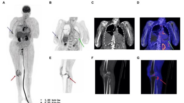 Sepsis por Haemophilus influenzae con taponamiento cardíaco y artritis bacteriana en paciente de 67 años Sepsis por Haemophilus influenzae con taponamiento cardíaco y artritis bacteriana en paciente de 67 años
