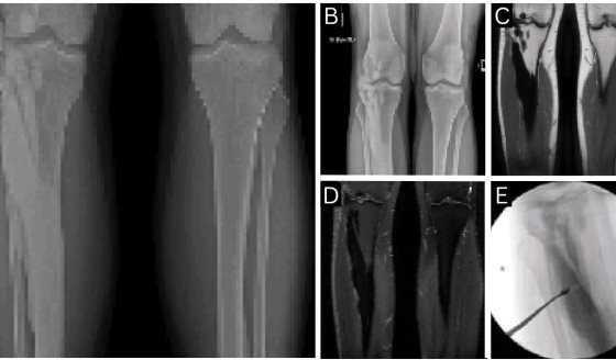 Dolor aislado en rodilla derecha como manifestación de melorreostosis con compromiso intraarticular