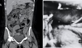 Hallazgo de perforación en el remanente gástrico en paciente que había sido sometida a bypass