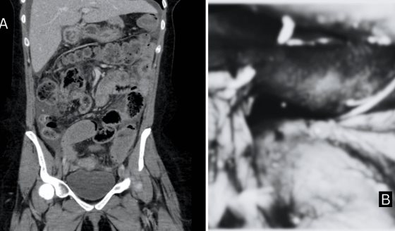 Hallazgo de perforación en el remanente gástrico en paciente que había sido sometida a bypass