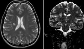 Mujer de 37 años presenta lesión similar a esclerosis concéntrica de Baló con evolución favorable