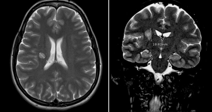 Mujer de 37 años presenta lesión similar a esclerosis concéntrica de Baló con evolución favorable