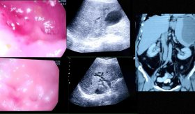 Pancreatitis crónica con colangitis aguda y trombosis de vena esplénica en paciente de 60 años 