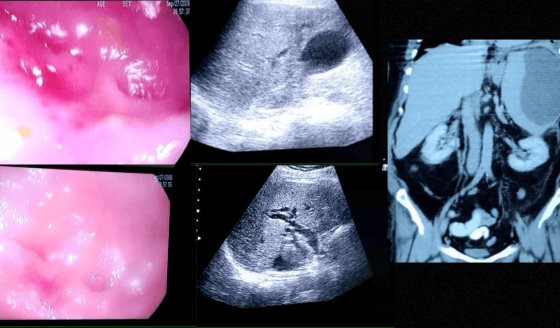 Pancreatitis crónica con colangitis aguda y trombosis de vena esplénica en paciente de 60 años 