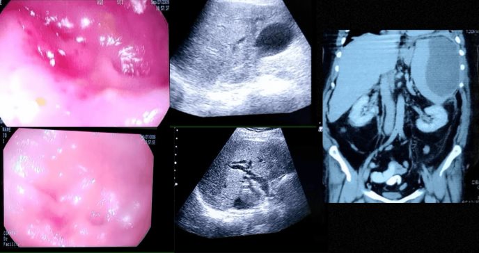 Pancreatitis crónica con colangitis aguda y trombosis de vena esplénica en paciente de 60 años 