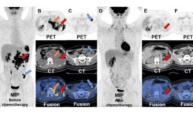 Teratoma testicular en adolescente con lesión persistente presenta metástasis detectadas por PET/CT