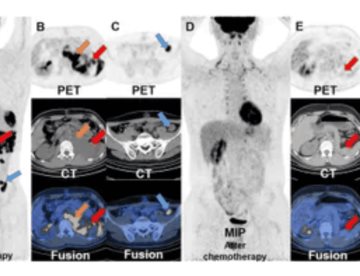 Teratoma testicular en adolescente con lesión persistente presenta metástasis detectadas por PET/CT