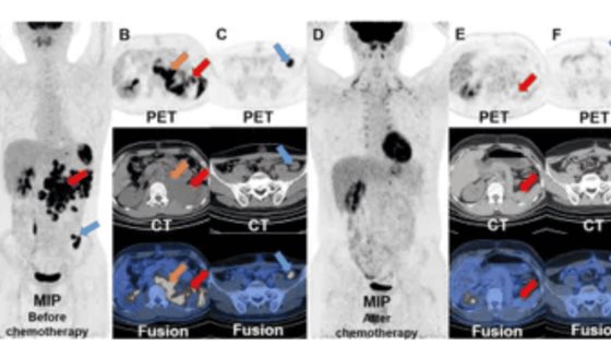 Teratoma testicular en adolescente con lesión persistente presenta metástasis detectadas por PET/CT