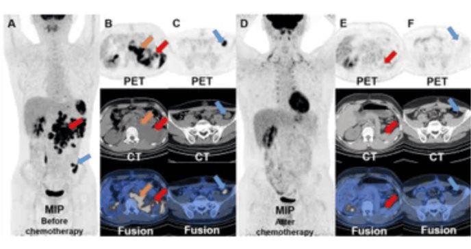 Teratoma testicular en adolescente con lesión persistente presenta metástasis detectadas por PET/CT