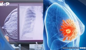 Mujeres jóvenes con alto riesgo de cáncer de mama no reconocen síntomas clave, según estudio