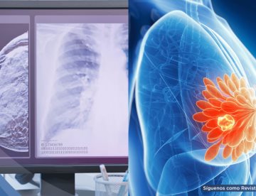 Mujeres jóvenes con alto riesgo de cáncer de mama no reconocen síntomas clave, según estudio