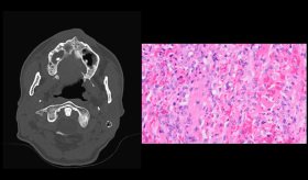 Sarcoma de Kaposi como primera manifestación de SIDA no diagnosticado en hombre de 52 años con anorexia 