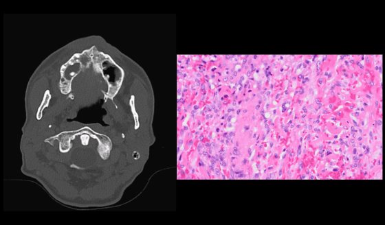 Sarcoma de Kaposi como primera manifestación de SIDA no diagnosticado en hombre de 52 años con anorexia 
