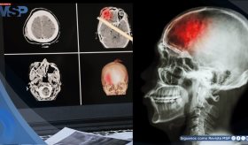 Estudio revela alto índice de hipertensión y diabetes en pacientes con ACV en el noroeste de Puerto Rico