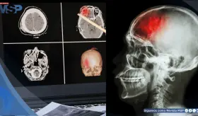 Estudio revela alto índice de hipertensión y diabetes en pacientes con ACV en el noroeste de Puerto Rico
