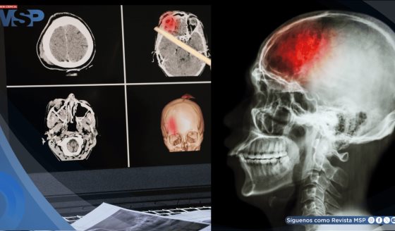 Estudio revela alto índice de hipertensión y diabetes en pacientes con ACV en el noroeste de Puerto Rico