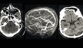 Uso indiscriminado de viagra ocasiona trombosis cerebral en paciente de 64 años