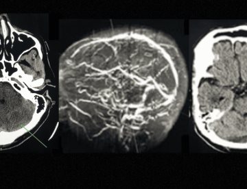 Uso indiscriminado de viagra ocasiona trombosis cerebral en paciente de 64 años