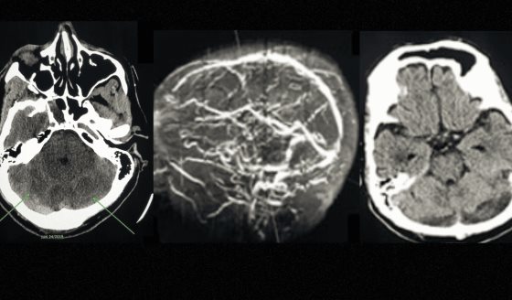 Uso indiscriminado de viagra ocasiona trombosis cerebral en paciente de 64 años