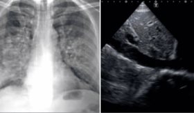 Reagudización renal por insuficiencia cardíaca en paciente adulto mayor con múltiples comorbilidades