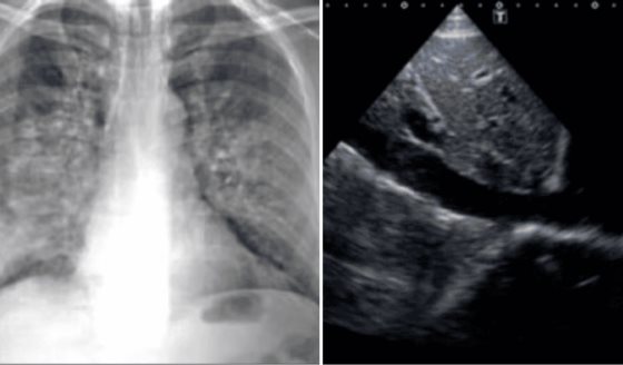 Reagudización renal por insuficiencia cardíaca en paciente adulto mayor con múltiples comorbilidades