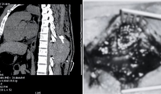 Hombre desarrolla paraplejia tres días después de cirugía de columna por sangrado tardío