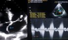 Quiste sanguíneo en válvula mitral con aneurisma es tratado erróneamente como cardiopatía reumática  