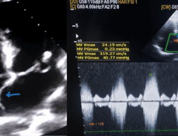Quiste sanguíneo en válvula mitral con aneurisma es tratado erróneamente como cardiopatía reumática  