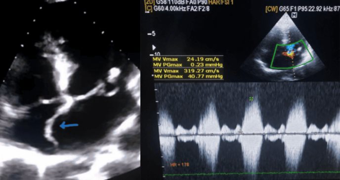 Quiste sanguíneo en válvula mitral con aneurisma es tratado erróneamente como cardiopatía reumática  