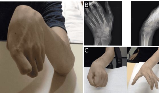 Tratamiento combinado con toxina botulínica y cirugía restaura movilidad en muñeca paralizada