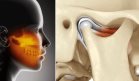 ¿Dolor en mandíbula, oído o cabeza? Podría deberse a la articulación temporomandibular y no a migrañas