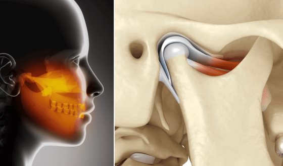 ¿Dolor en mandíbula, oído o cabeza? Podría deberse a la articulación temporomandibular y no a migrañas
