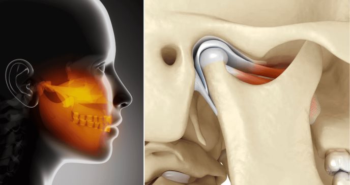 ¿Dolor en mandíbula, oído o cabeza? Podría deberse a la articulación temporomandibular y no a migrañas