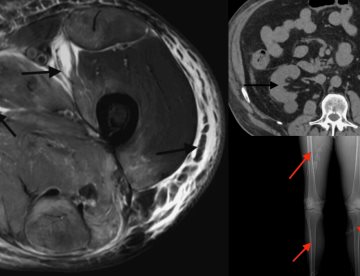 Rabdomiólisis fulminante por atorvastatina en hipotiroidismo no controlado: Fallo multiorgánico evitable