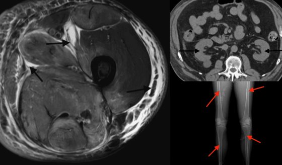 Rabdomiólisis fulminante por atorvastatina en hipotiroidismo no controlado: Fallo multiorgánico evitable