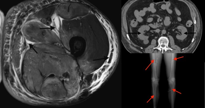 Rabdomiólisis fulminante por atorvastatina en hipotiroidismo no controlado: Fallo multiorgánico evitable