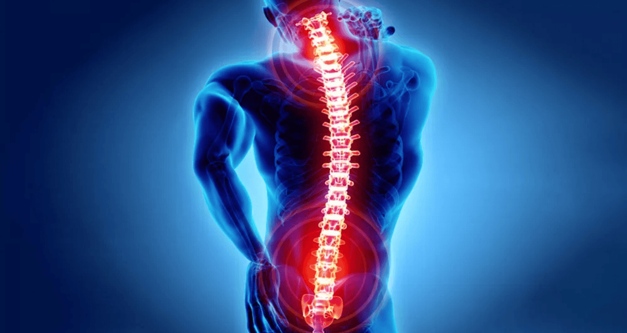 Nuevos criterios para espondiloartritis axial con especificidad del 90 % y mejor sensibilidad