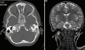 Acumulación de células de Langerhans ocasiona pérdida auditiva e inestabilidad en infante