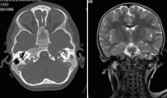 Acumulación de células de Langerhans ocasiona pérdida auditiva e inestabilidad en infante