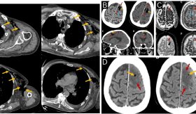 Paciente con gangrena gaseosa por Clostridium septicum desarrolla embolia cerebral aérea