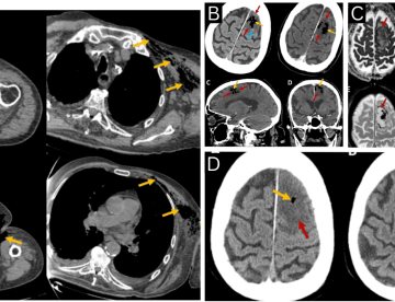 Paciente con gangrena gaseosa por Clostridium septicum desarrolla embolia cerebral aérea