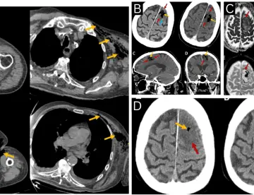 Paciente con gangrena gaseosa por Clostridium septicum desarrolla embolia cerebral aérea